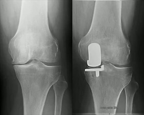 Arthrose interne du genou gauche traitée avec une prothèse partielle unicompartimentale du genou
