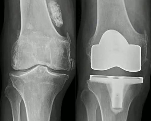Arthrose tri compartimentale du genou, traitée avec une prothèse totale du genou