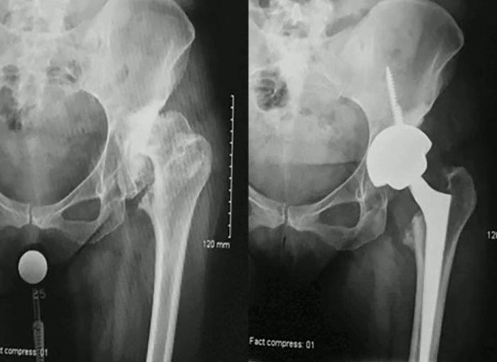 Jeune femme atteinte de dysplasie de la hanche gauche et d'arthrose sévère.