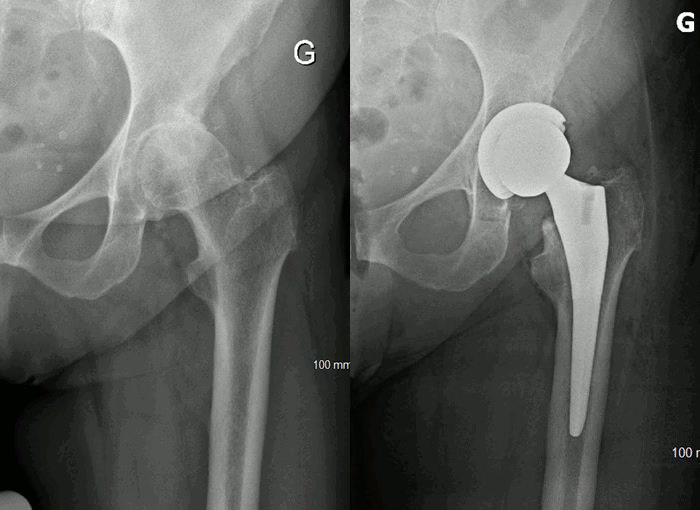 Arthrose de la hanche traitée par un remplacement total de la hanche et une tête en céramique de grand diamètre.